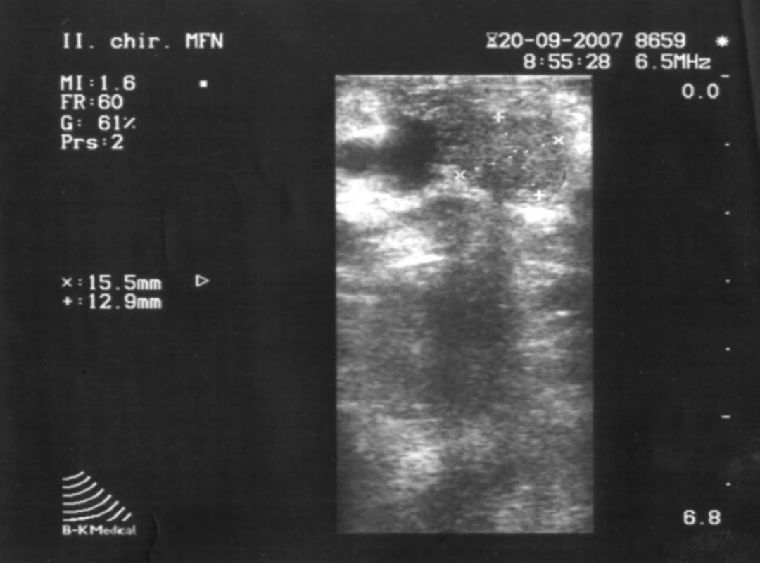 Peroperačná ultrasonografia (lokalizácia vyznačená šípkami).
Fig. 2. Per operation ultrasonography (localization demarked with arrows).