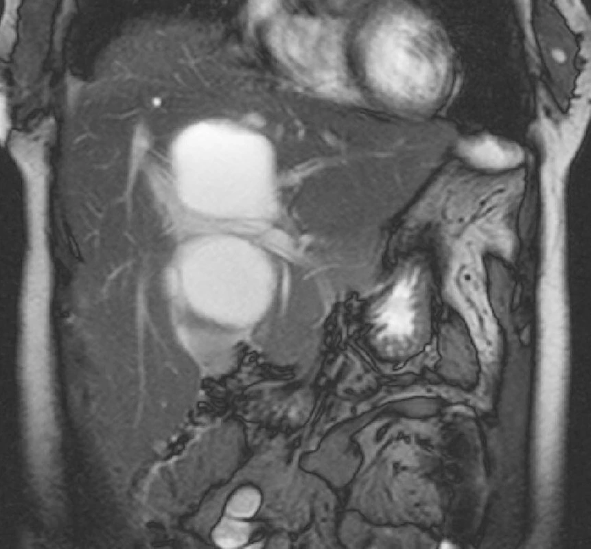 MR jater, T2-vážený obraz v koronární rovině. Je patrný vztah ložiska k portální žíle a jejím větvím.
Fig. 3. Liver MRI, T2-weighted view, coronary plane. Relation between the focus and the portal vein and its branches is detectable.