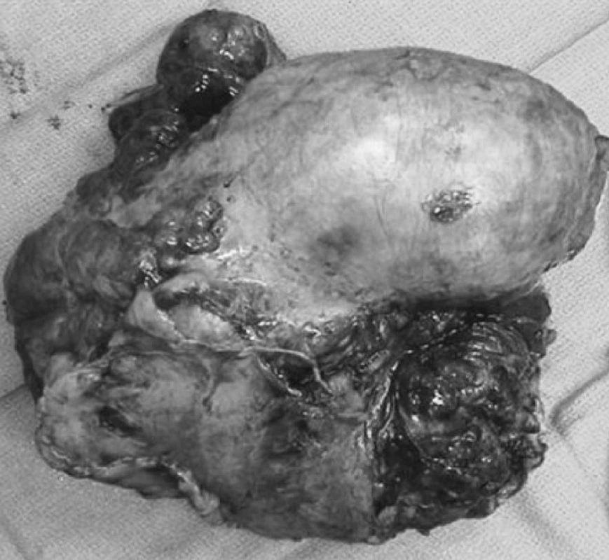 Resekát SFT s plicním lalokem
Fig. 3. SFT resecate with a pulmonary lobe