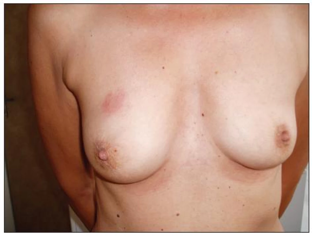 Nález na pravém prsu
Fig. 9. The right breast finding
