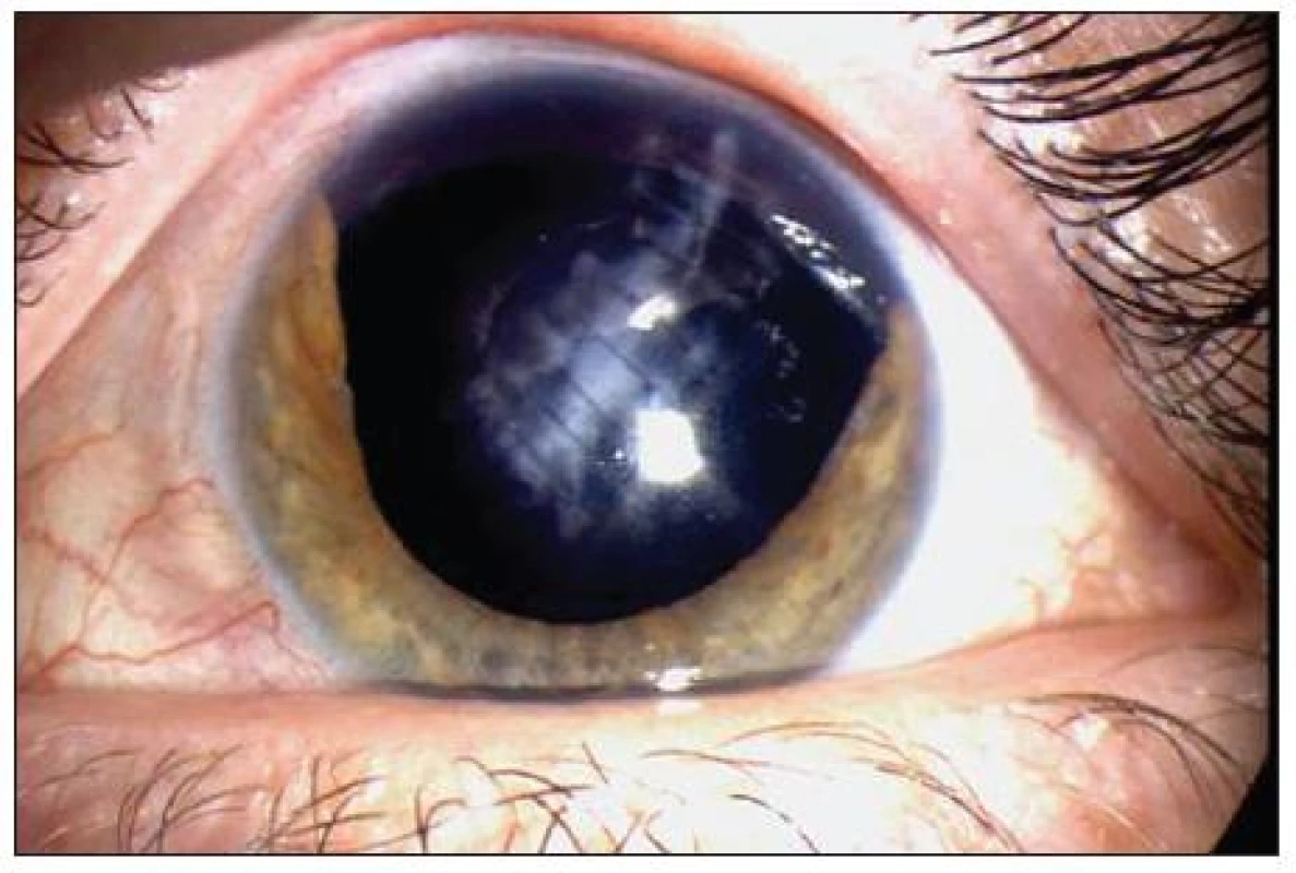 Nález před implantací hnědé PC IOL Ophtec