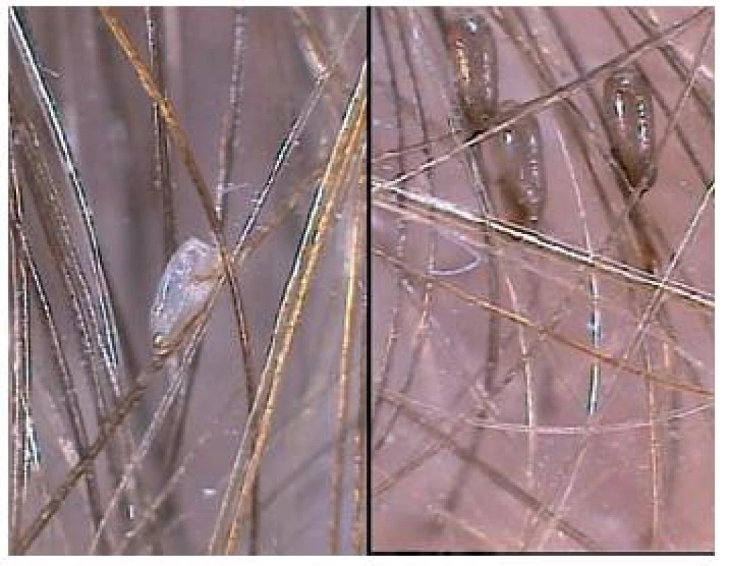 Pediculosis capitis
Vlevo prázdná hnida, vpravo plná.