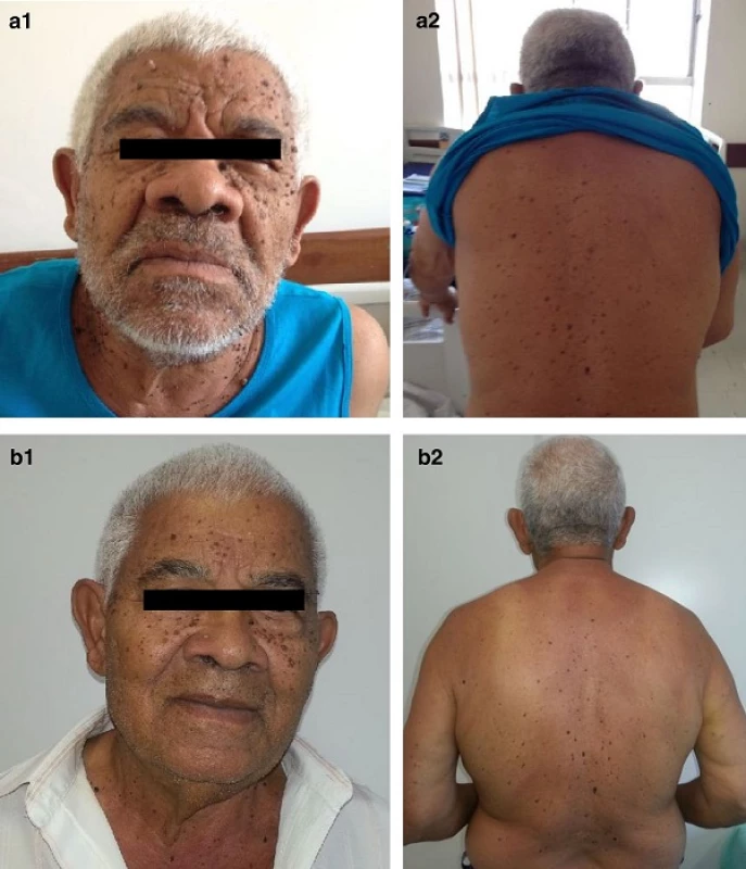 Sign of Leser-Trélat. Multiple lesions on the face (<b>a</b>) and back of the patient (<b>b</b>) compatible with seborrheic keratoses