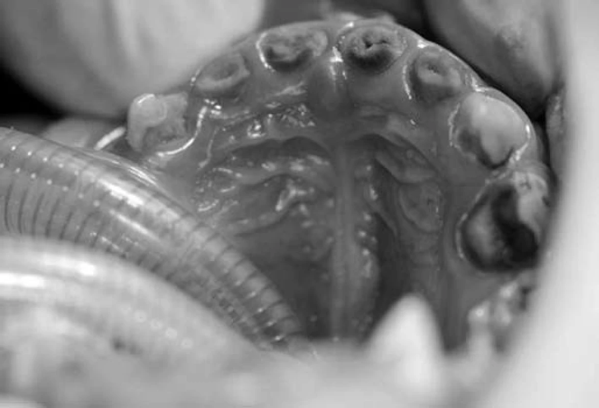 Kompletně destruované zuby v horní čelisti.
Fig. 4. Complete decayed teeth in the upper jaw.