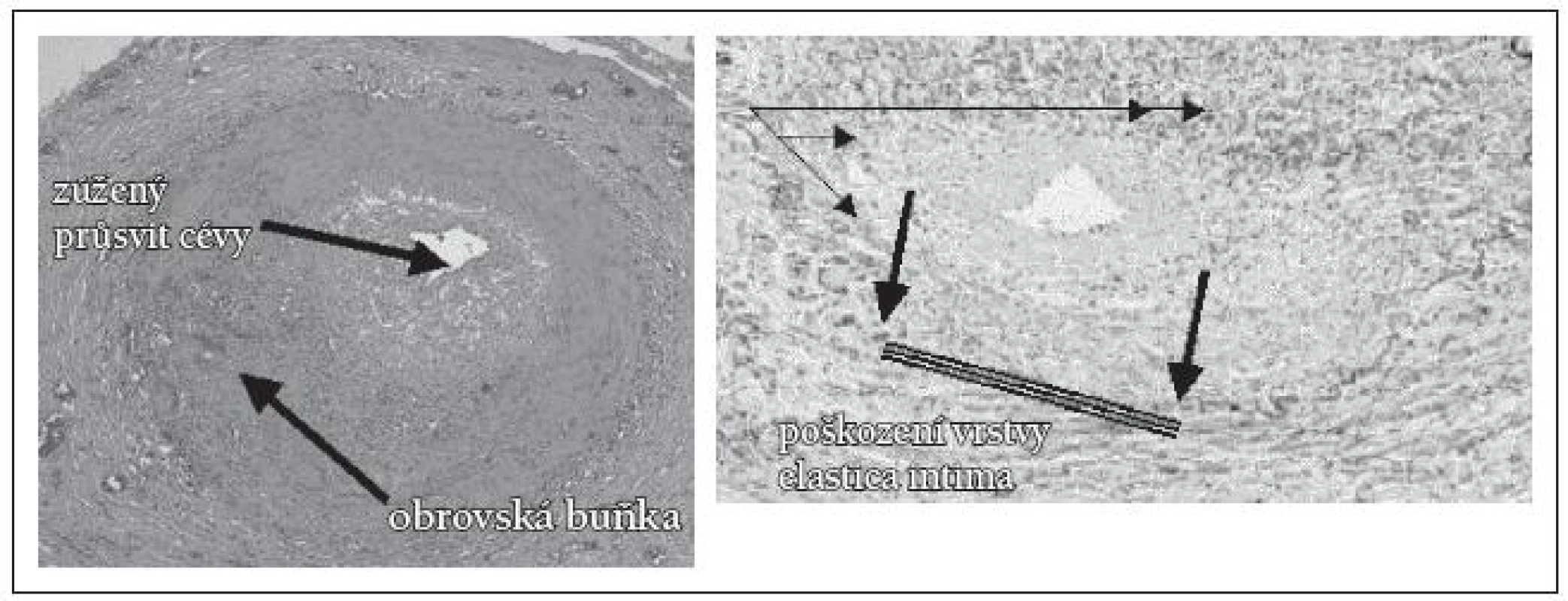 Histologický nález při TA [17].