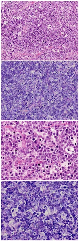 Photomicrographs of a histological section showing a population of B-cell lymphoma of the Burkitt type arising in the pituitary gland – neoplastic lymphoid cells with pale macrophages forming the typical “starry sky” pattern (immunohistochemical stains not shown)
A) H &amp; E stain, original magnification x 20, B) H &amp; E stain, original magnification x 40,
C) Giemsa stain, original magnification x 20, D) Giemsa stain, original magnification x 40