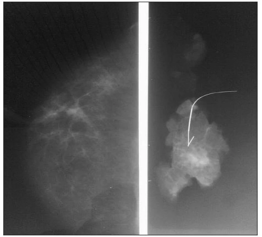 Rádiohistogram pri nehmatnej lézii so zavedeným vodičom
Fig. 6. Radiohistogram in a nonpalpable lesion with a guide introduced into the tissue