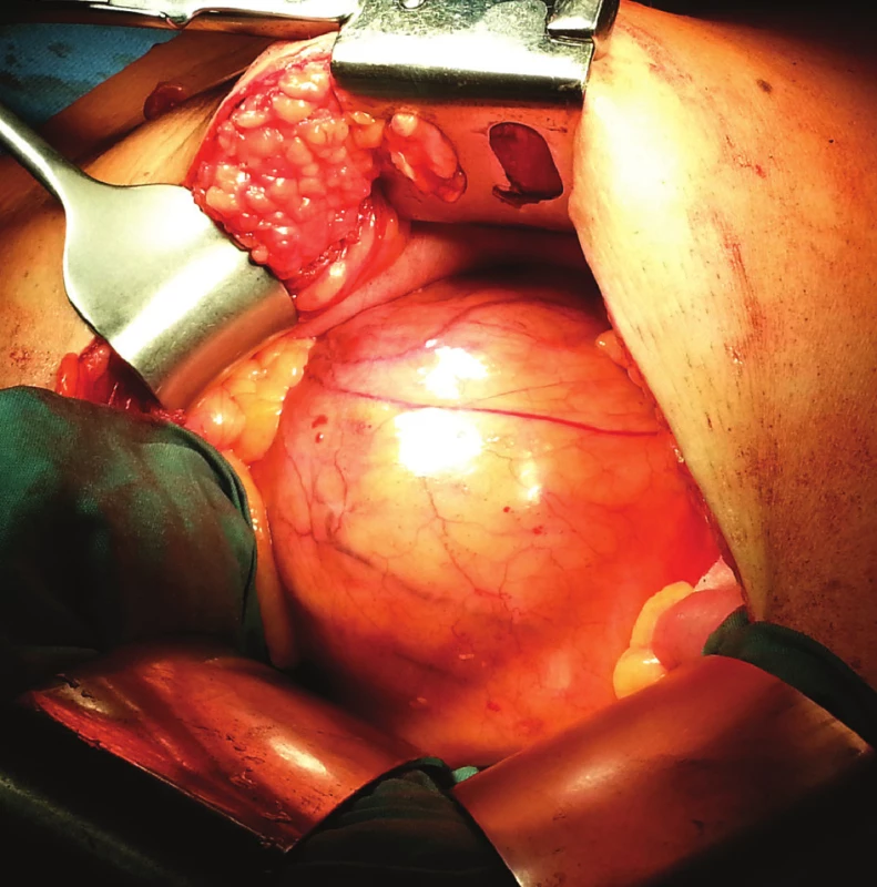 Perioperačně cysta in situ
Fig. 2: Intraoperative, the cyst in situ