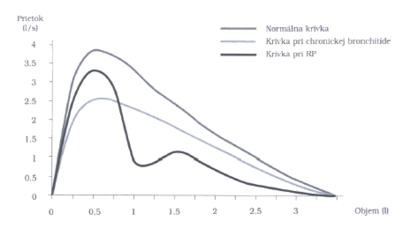 Krivka expiračného prietoku znázorňujúca vrcholové prietokové rýchlosti pri rôznych pľúcnych objemoch. Pri distálnej obštrukcii (astma, chronická bronchitída) je najviac ovplyvnený prietok pri nízkych objemoch, pri proximálnej obštrukcii (trachea) je ovplyvnený prietok pri vysokých objemoch
