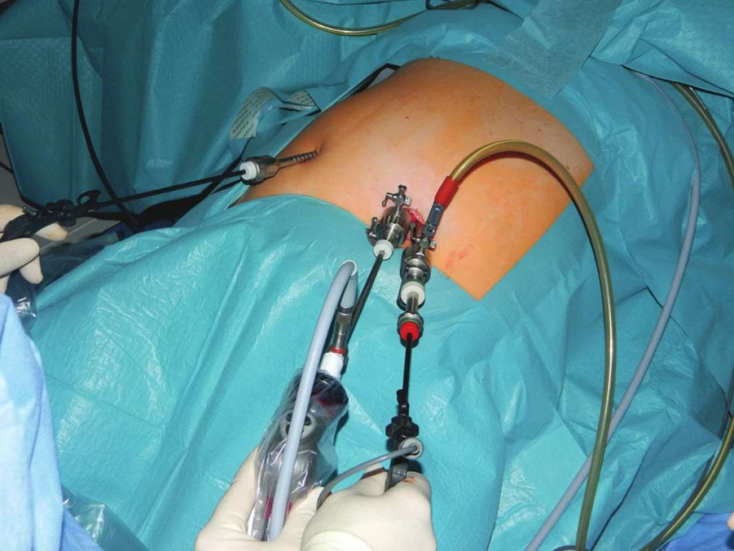 Pozice pracovních nástrojů DILS cholecystektomie
Fig. 2: Position of instruments for DILS cholecystectomy