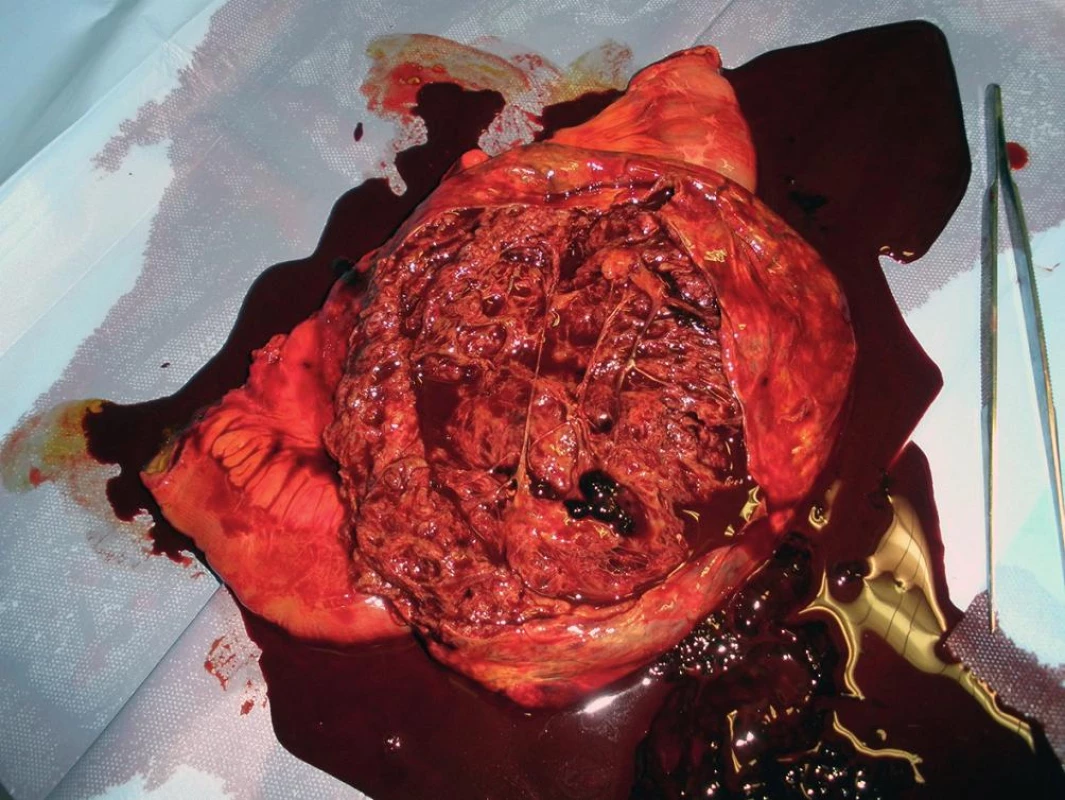 Resekát jejuna s GIST – druhá strana preparátu
Fig. 7: Resection specimen of jejunum with the GIST – the other side of the specimen