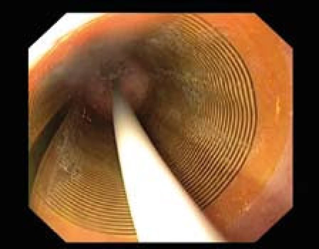 Léčba RFA – HALO<sup>360</sup>. Pohled endoskopu skrze nafouknutý balon, kdy se aplikuje RFA.
Fig. 1. RFA treatment – HALO<sup>360</sup>. Endoscopic view through an inflated balloon when RFA is applied.