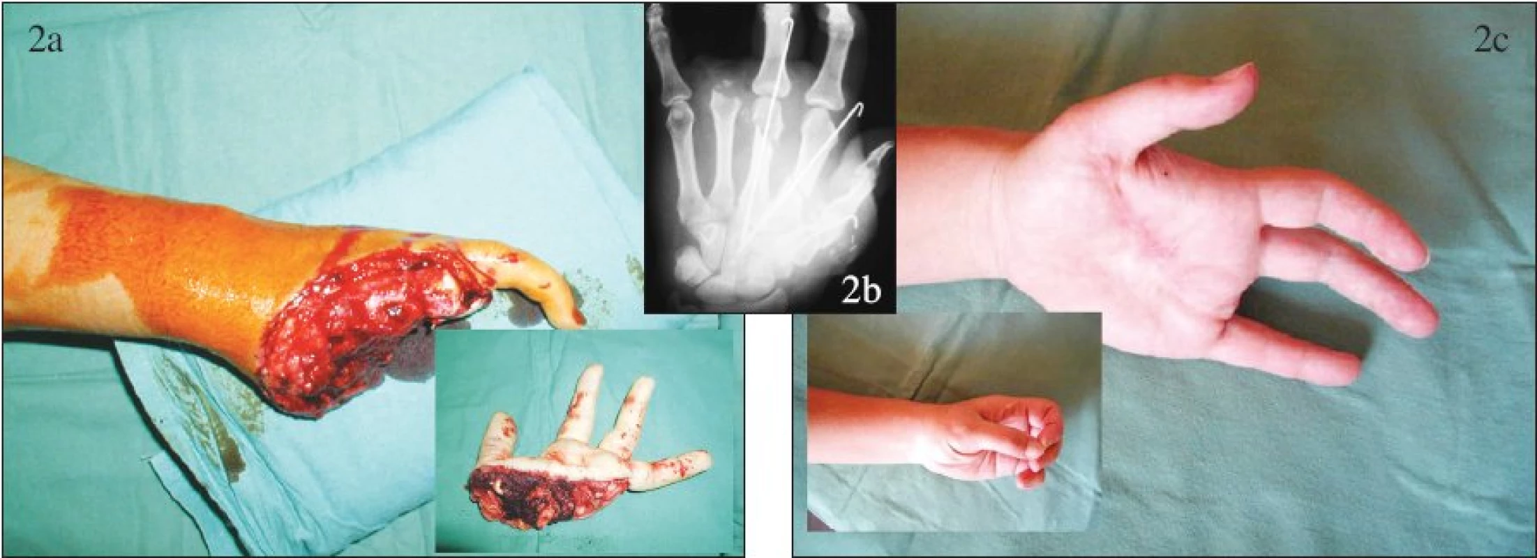 Replantace v oblasti dlaně: a – nález po úrazu s amputací ve dlani, b – pooperační RTG snímek, c – stav po replantaci.
Fig. 2. Palm region replantation: a – amputation in the palm following the trauma, b – postoperative x-ray view, c – post- replantation condition.