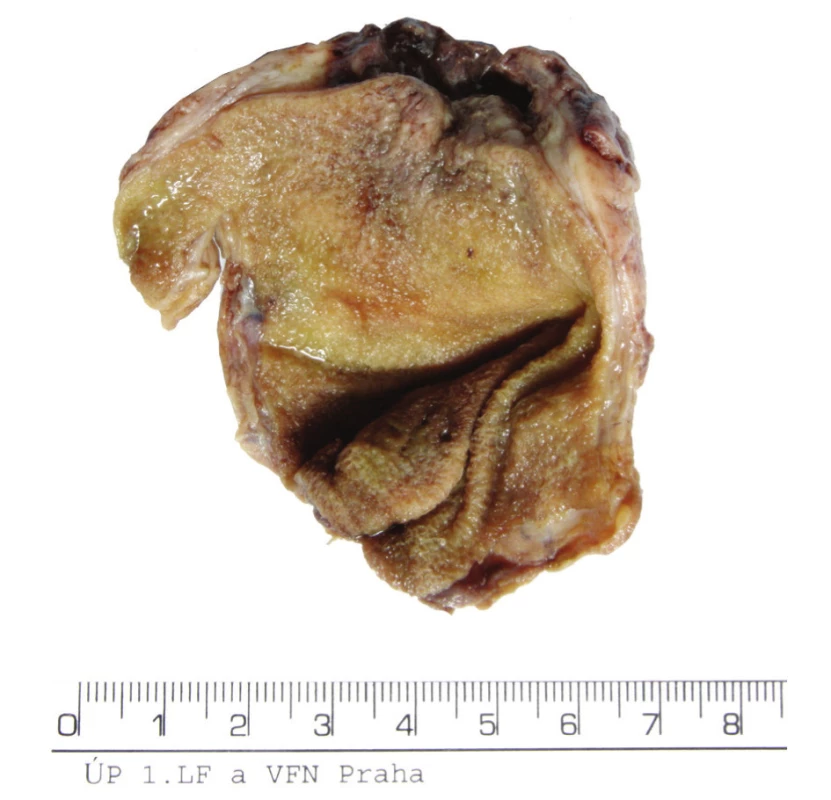 Preparát – fotografie celého žlučníku
Fig. 3. Preparation – a photo of the whole gall bladder