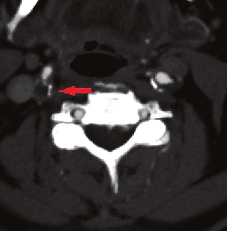 Volně vlající trombus a odstupová stenoza vnitřní karotidy
Fig. 1: Free-floating thrombus and bifurcation stenosis of the internal carotid artery