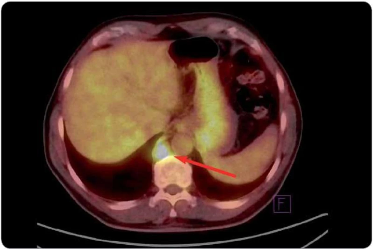 Obraz celotělového PET vyšetření zobrazující první relaps onemocnění (3/2008). Šipka ukazuje metabolicky aktivní infiltrát retrokrurálně.