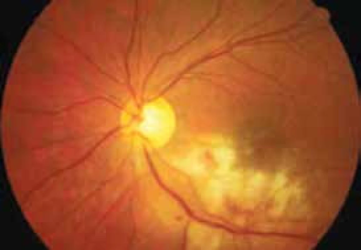 CMV retinitis