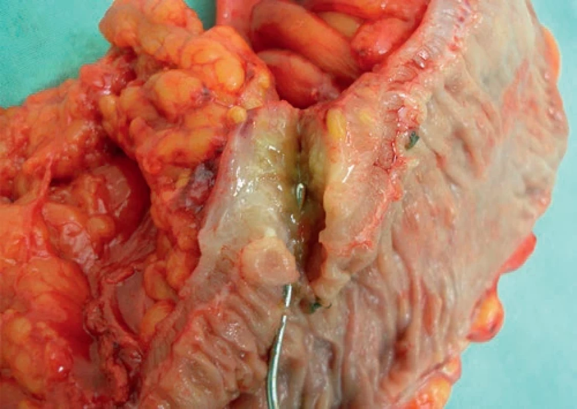 Inveterovaná divertikulární perforace sigmoidea. Bowel resection with inverted perforation.
