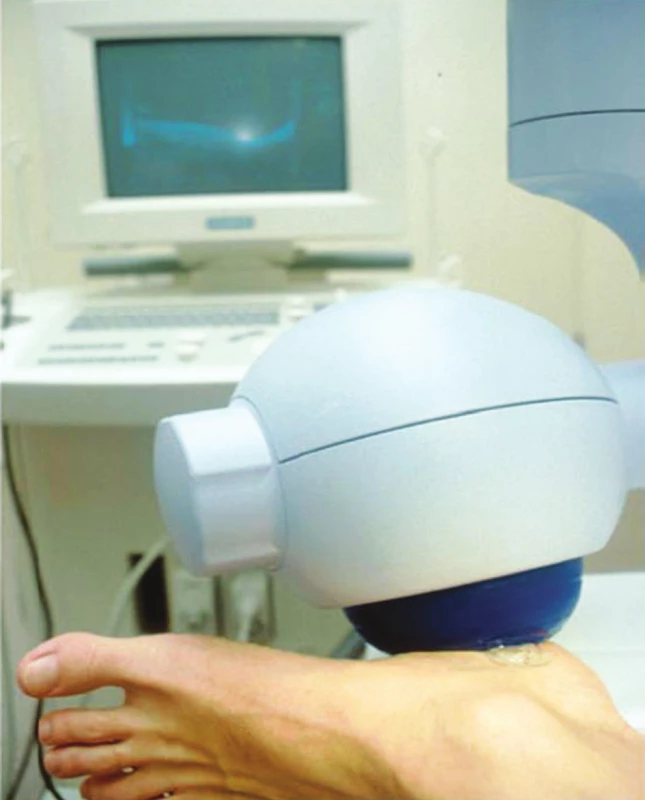 Doporučená aplikace ESWT u plantární fasciitis. (Převzato z Rompe et al., 2005.)