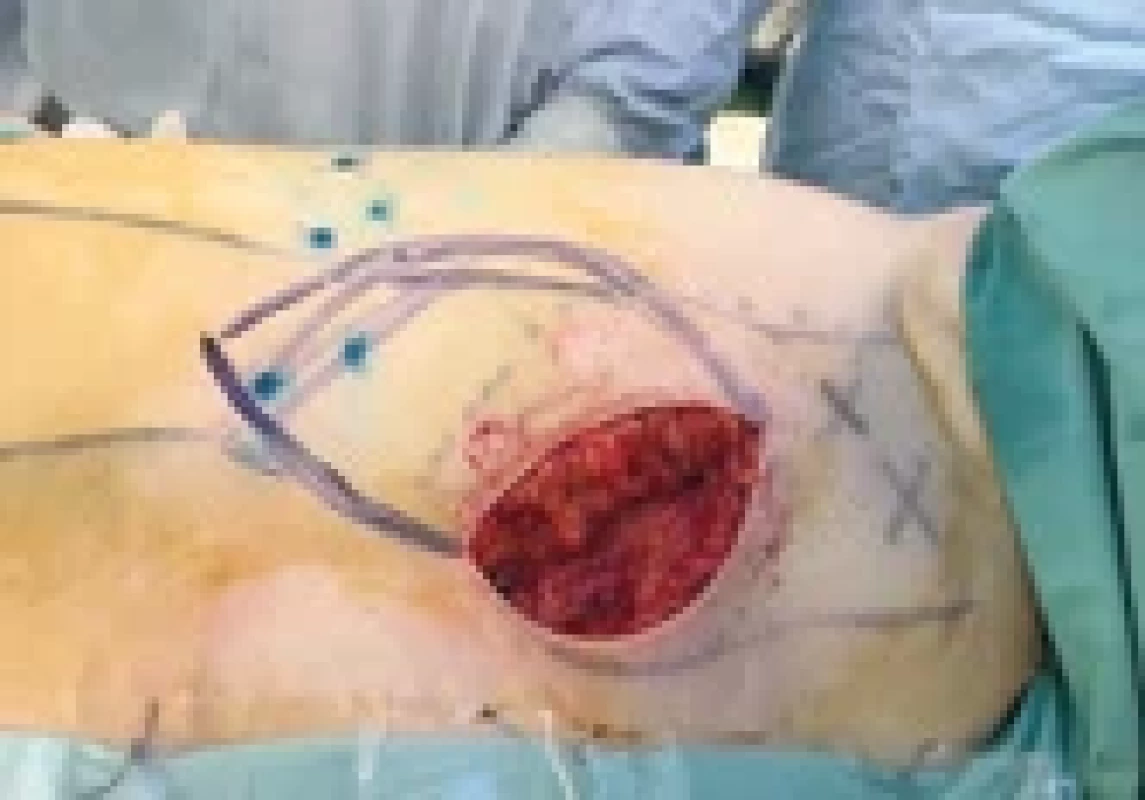Isolation of pedicle of thoracic skin fl ap with detected lymph nodes.