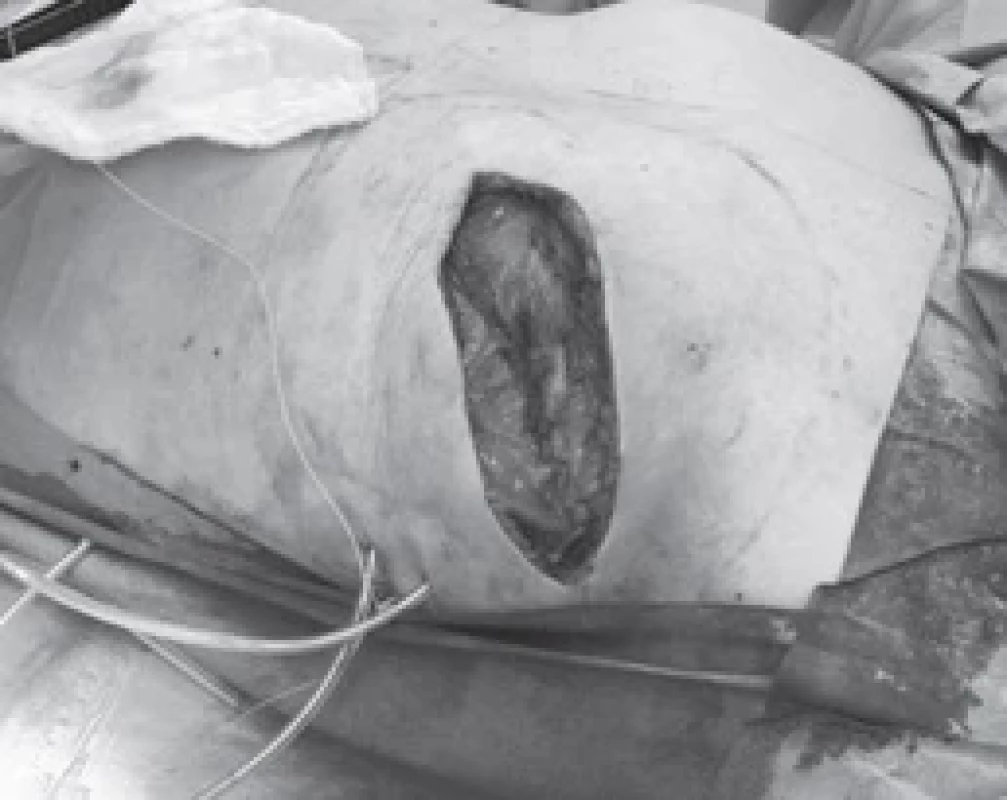 ADM sutured to the lower border of the pectoralis muscle, tissue expander is already inserted under the ADM.