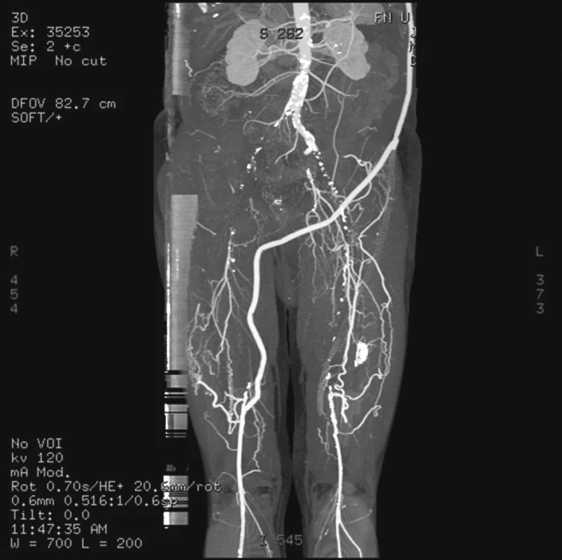 CT angiografie zobrazující uzávěr distální části axillobipopliteálního bypassu vlevo
Fig. 5. CT angiography showing the occlusion of the left distal part of the axillobipopliteal bypass
