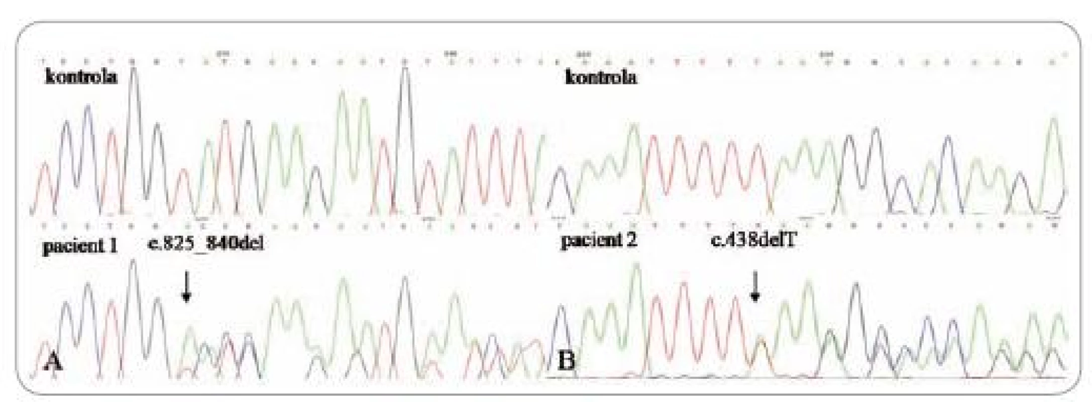 Sekvenačný elektroforeogram: A – posunová mutácia v 8. exóne (delécia 16 nukleotidov), B – delécia T v 5. exóne.