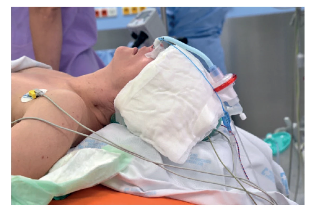 Poloha pacientky na operačním stole<br>
Fig. 1: Position of the patient on the operating table