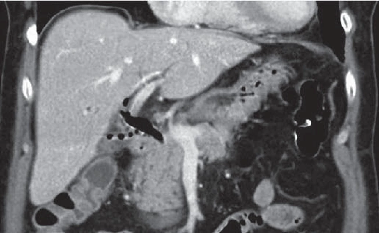 CT vyšetření – významná aerobilie.
Fig. 1. CT scan – significant aerobilia.