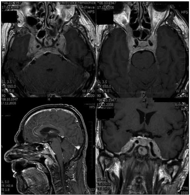 Rozsah tumoru na vstupní magnetické rezonanci mozku. Tumor infiltrující klivus, kost klínovou a pyramidy spánkové kosti, prorůstá do kavernózních sinů oboustranně a propaguje se dále do optického kanálku vpravo, současně je patrné sycení tumorózních mas v nazofaryngu.