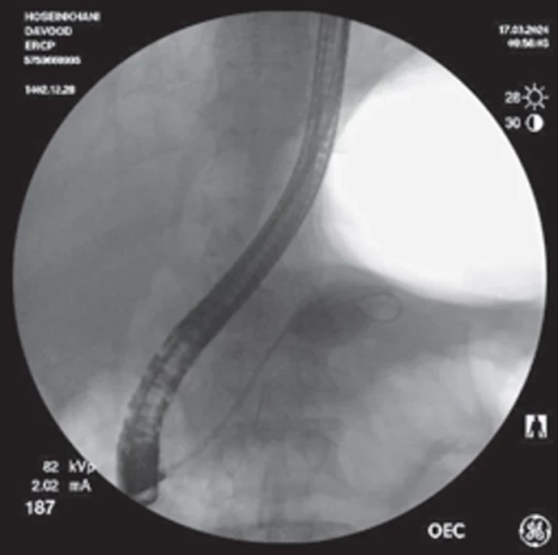  Tight anastomotic stricture in the biliary-enteric anasto mosis of a 43-year-old male patient post-OLT (patient 3).  Coronary balloon dilation (3 mm) was performed successfully,  allowing placement of a -10mm Kaffes stent. Obr. 3. Těsná anastomotická striktura v bilio-enterální anastomóze 43letého muže po OLT (pacient 3). Úspěšně byla provedena koronární balónková dilatace 3( mm), která umožnila umístění 10mm Kaffesova stentu.