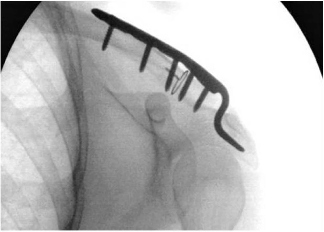 Zlomenina klíčku Neer IIb po stabilizaci háčkovou dlahou
Fig. 6: Neer IIb clavicle fracture, result after stabilisation using a hook plate