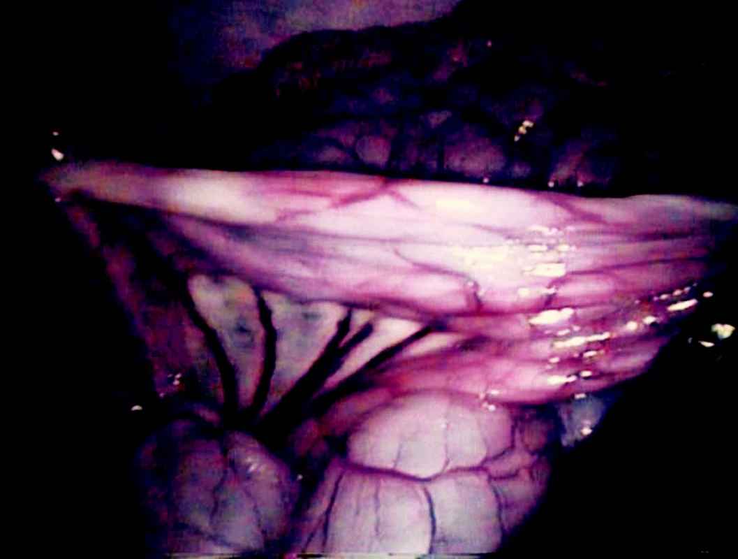Hranice ischemie střeva v bílém světle při prosté laparoskopii
Fig. 6. The border of intestinal ischemia during laparoscopy in white light