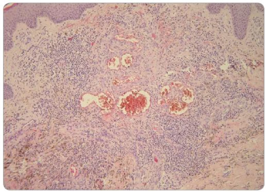 V prominující části léze je skupina nepravidelně tvarovaných a velikých cév obklopená zánětlivým infi ltrátem, extravazálními erytrocyty a depozity hemosiderinu. Kolagenní vazivo je ložiskovitě zhrubělé (HE, zvětšení 200krát).
Foto: doc. MUDr. L. Pock, CSc.