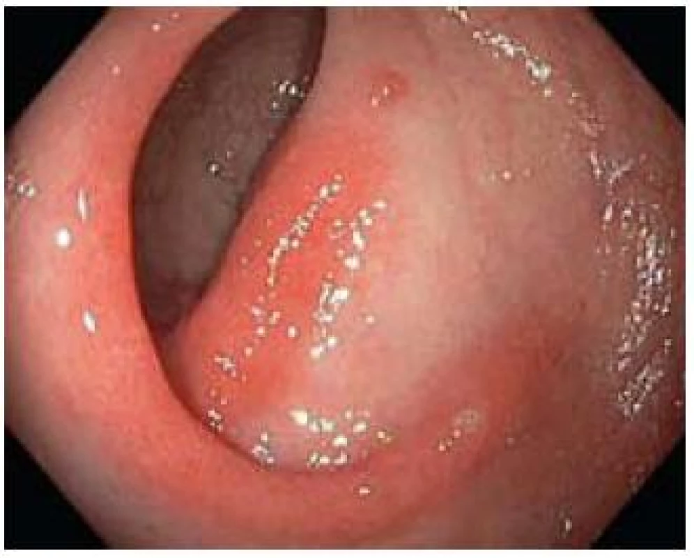 Erytematozní forma.
Fig. 1. Erythemathous type.