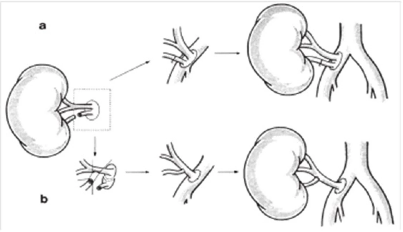 a,b: Oprava poškodenej segmentálnej artérie a) priama oprava a b) reinplantácia do väčšej renálnej cievy [11]
Fig. 3. a,b: Repair of damaged segmental arteries a) direct repair and b) reimplantation in greater renal arteries [11]