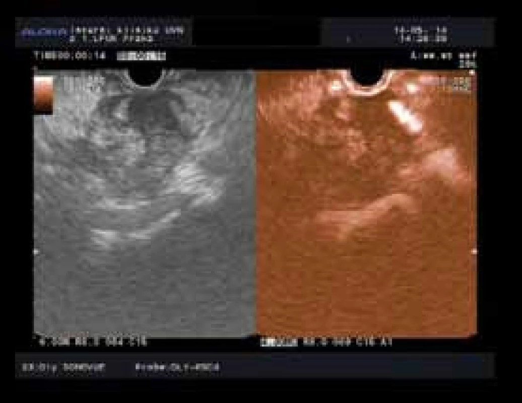 Hypoenhancement typický pro karcinom pankreatu s arteriální invazí.
Fig. 1. Pancreatic cancer with typical hypoenhancement and with arterial invasion.