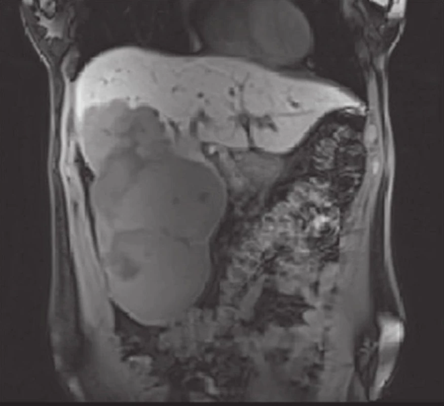 Magnetická rezonance jater – gigantický solitární hemangiom jater s průměrem 19,1 cm řešený enukleací
Fig. 1: Magnetic resonance imaging of the liver – solitary giant liver hemangioma (19.1 cm in diameter) managed using enucleation