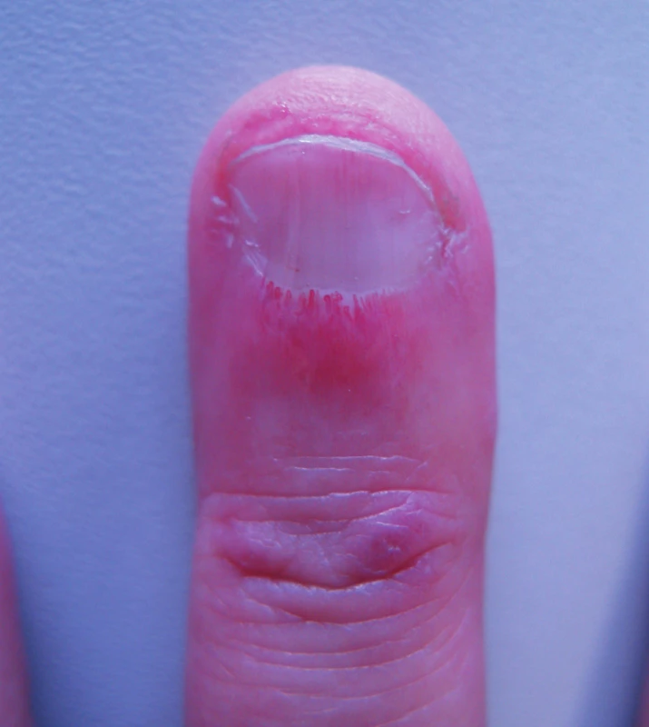 Nehtové lůžko u dermatomyositidy – viditelná redukce kapilár, jejich ektázie, avaskulární zóna – vedle ní „keříčkovitě“ se větvící kapilára, červené makulopapuly nad interfalangeálním kloubem (z archivu prof. J. Štorka, CSc.).