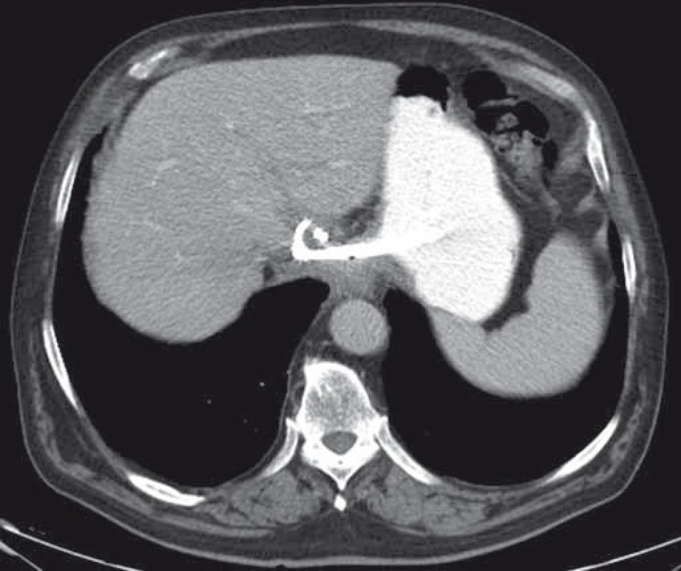CT – úplná regresia abscesu dva mesiace po drenáži, double-pigtail stenty in situ.
Fig. 9. CT – complete resolution of an abscess two months after drainage, double-pigtail stents in situ.