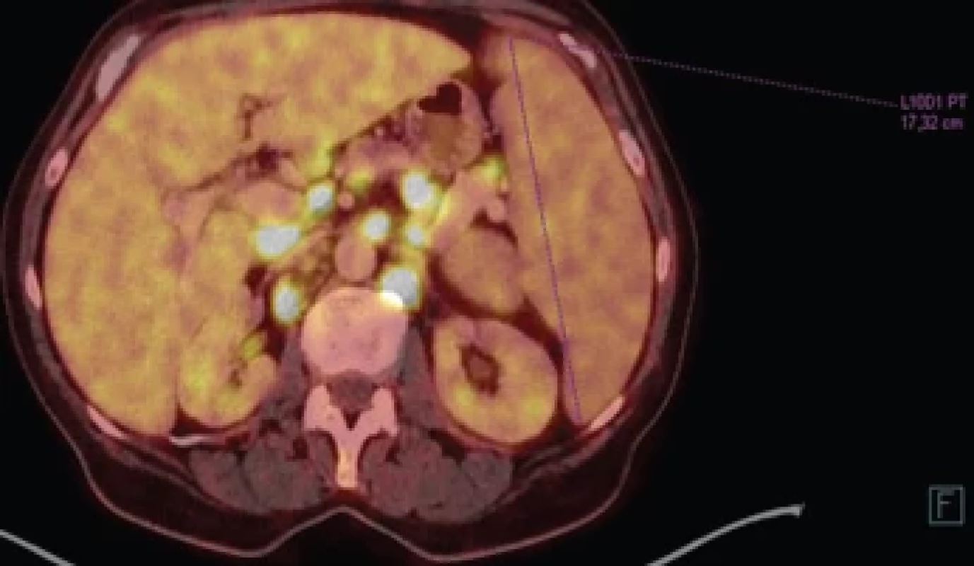 PET/CT. Zvýšená akumulace 18F-FDG ve vícečetných zvětšených LU nad i pod bránicí, v mnohočetných ložiscích obou plic i na pleuře, ojediněle v ložisku na peritoneu. Splenomegalie.
