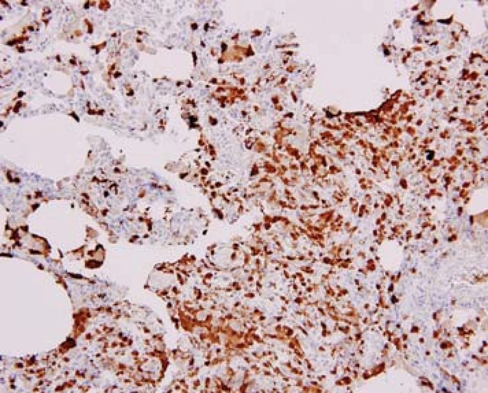Imunohistochemická pozitivita ve vyšetření s protilátkou proti S100 proteinu (původní zvětšení 200x).