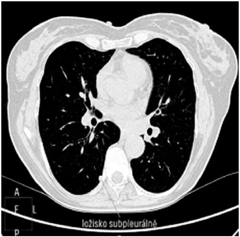 Nález počítačové tomografie – subpleurální ložisko sarkoidózy