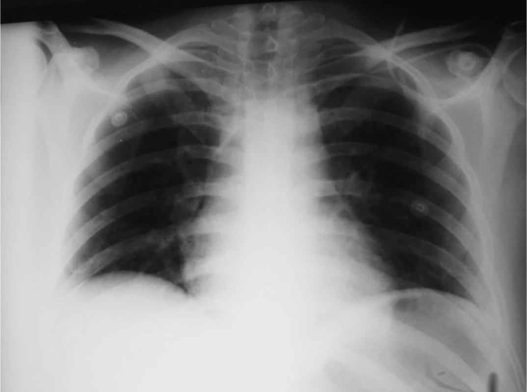 RTG plic – poloha CŽK po zavedení
Fig. 1. Pulmonary x-ray – the venous line localization following its introduction