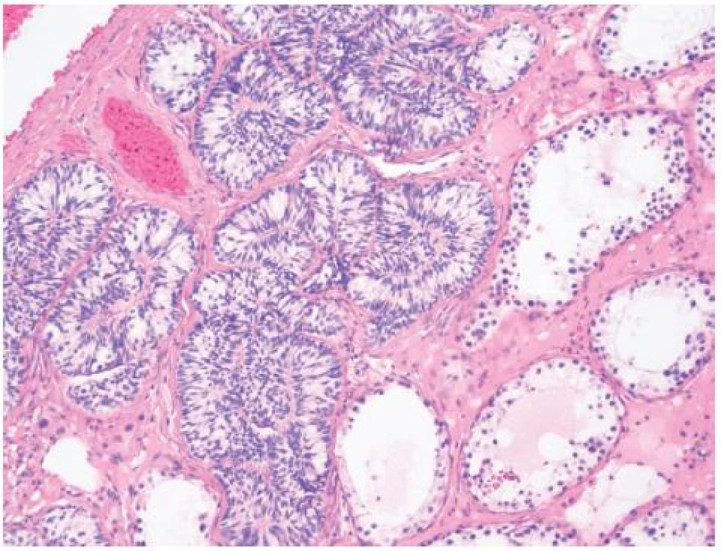 Náhodný nález Pickova adenomu v parenchymu varlete
Fig. 3. Incidental Pick’s adenoma in parenchyma of the testis
