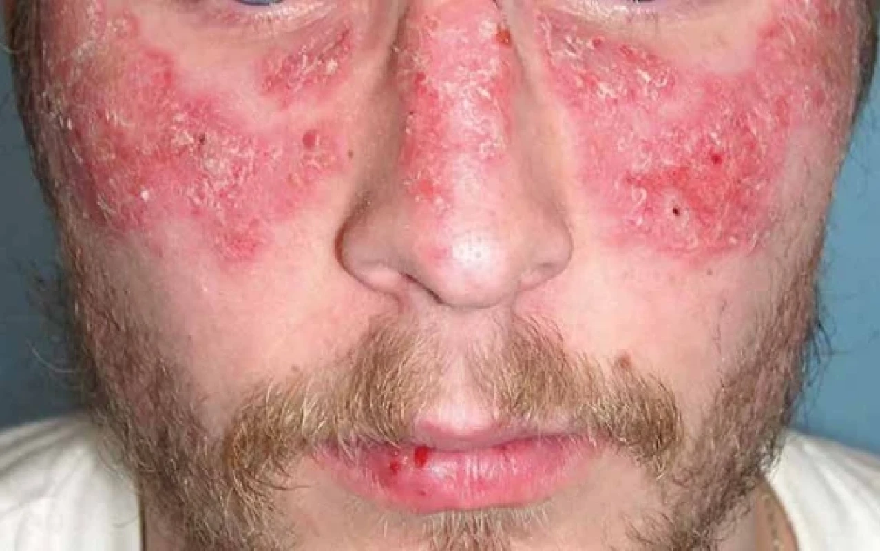 Systémový erythematodes s diskoidními projevy