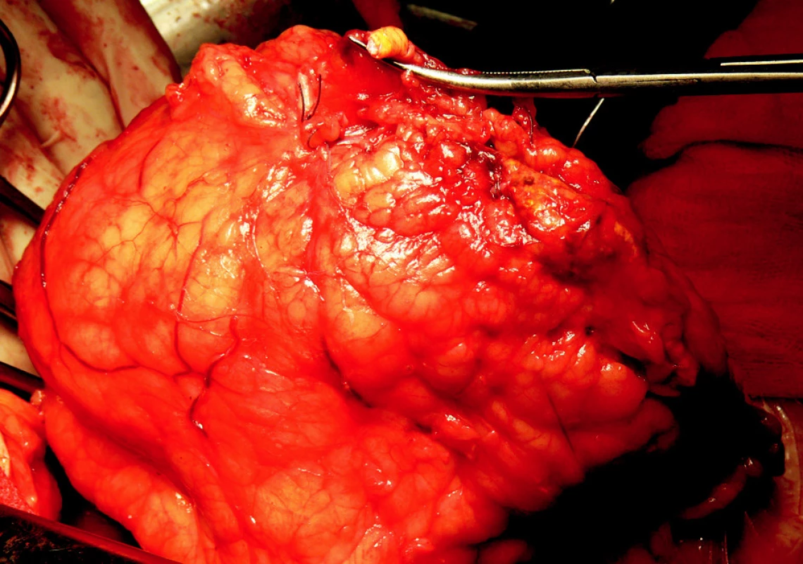 Levostranná radikální nefrektomie
Fig. 3. Left- sided radical nephrectomy