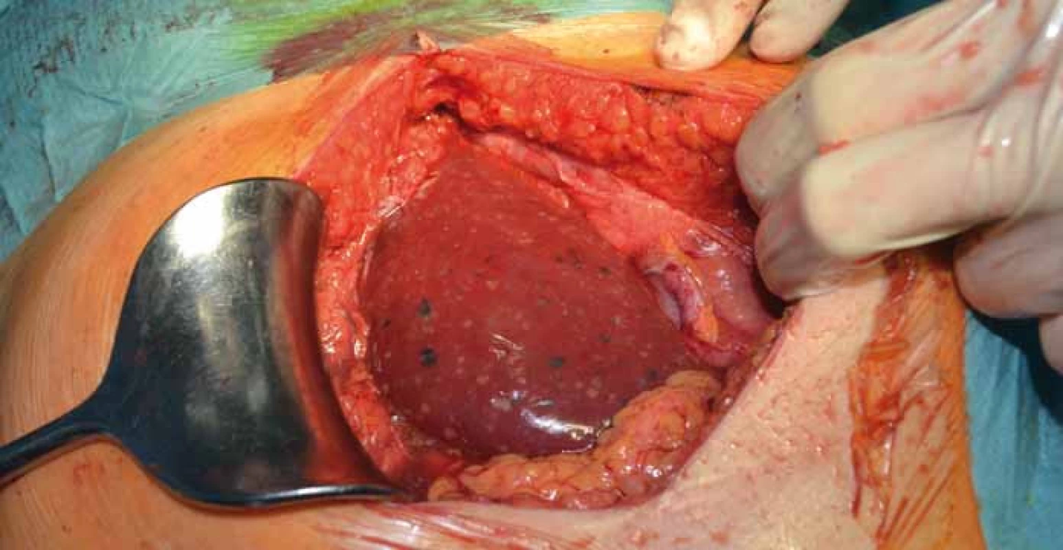 Alveolárna echinokokóza pravého laloka pečene. Makroskopicky viditeľná ako biele a tmavé body na povrchu pečene.
Fig. 3. Alveolar echinococcosis of the right lobe of the liver. Macroscopically visible as white and dark spots on the surface of the liver.