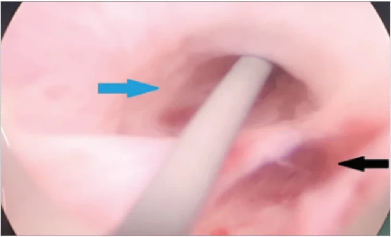 Large urethral false passage creating a pseudo-lumen (marked by black arrow) of almost the same caliber as the true lumen (marked by blue arrow).