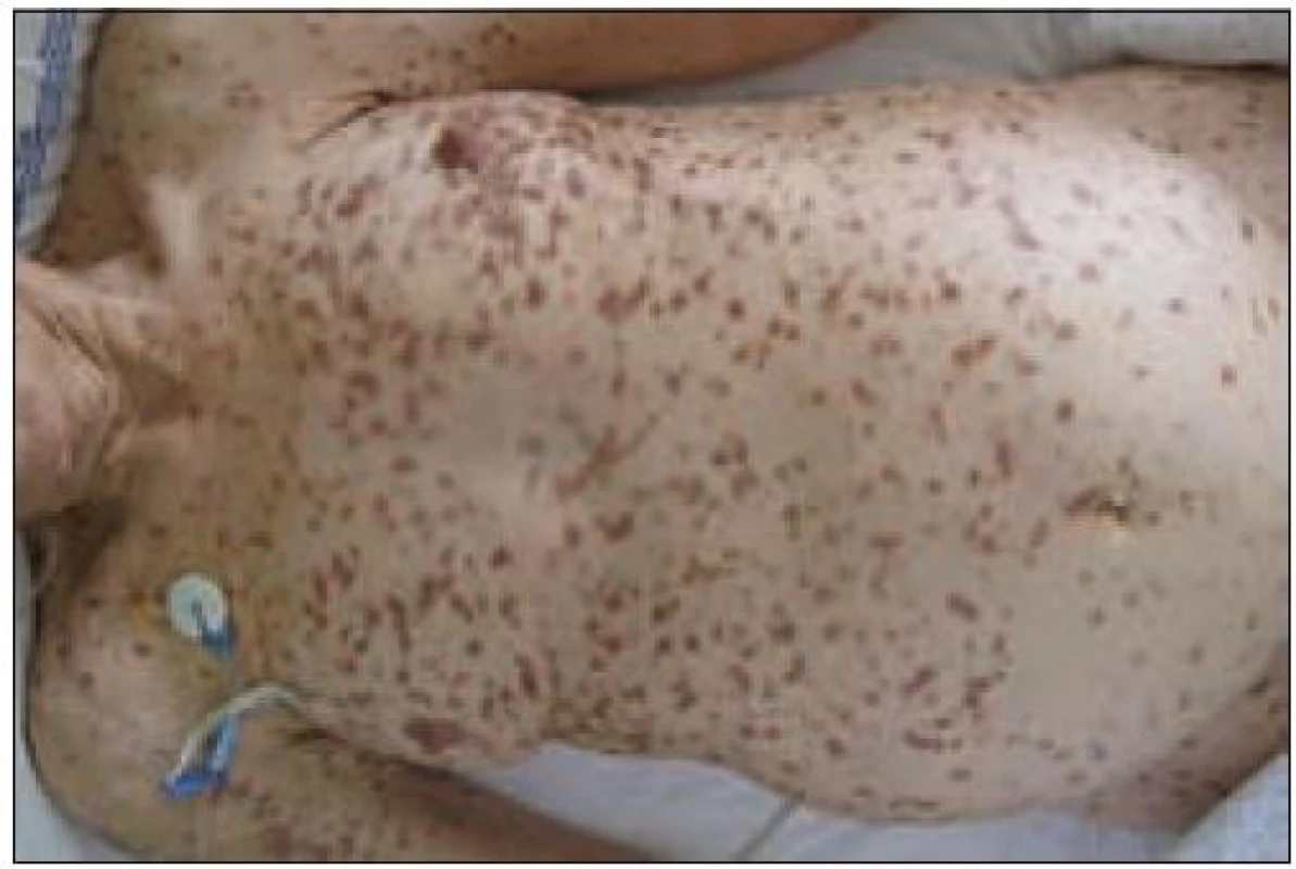 Urticaria pigmentosa u pacientky s agresivní systémovou mastocytózou, hepatomegalií a ascitem. Snímek MUDr. Petr Szturz.
